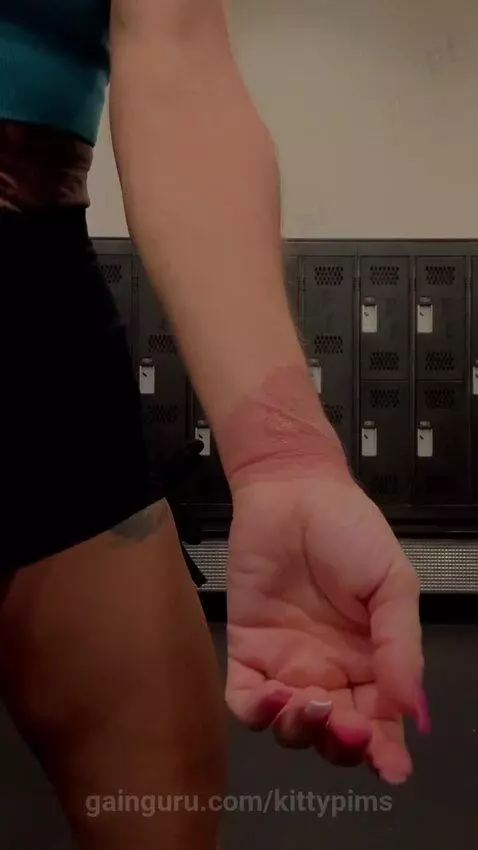 Second degree burn … but no excuses by kittypims